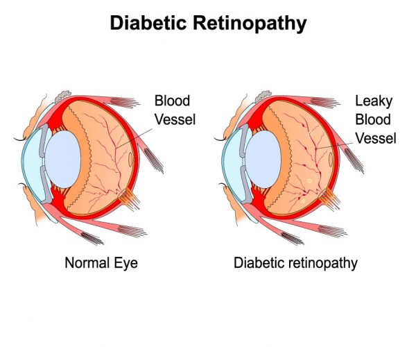 Diabetic Retinopathy Image